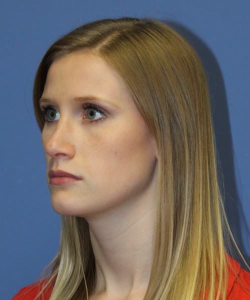 Rhinoplasty 1751 – Click HERE for more views after photo. Individual results may vary.