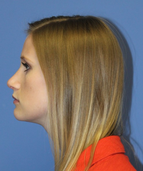 Rhinoplasty 1751 – Click HERE for more views after photo. Individual results may vary.