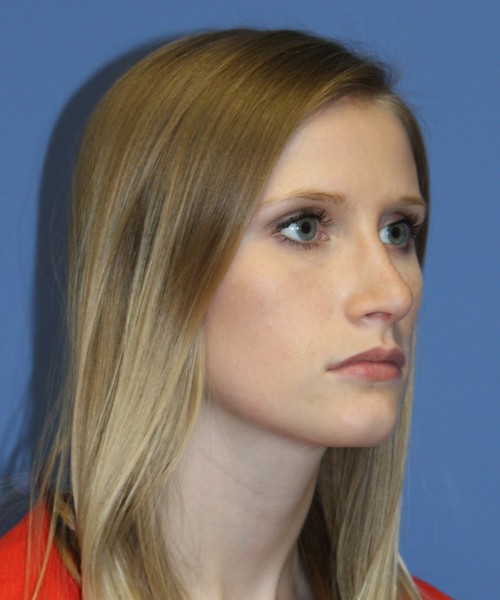 Rhinoplasty 1751 – Click HERE for more views after photo. Individual results may vary.