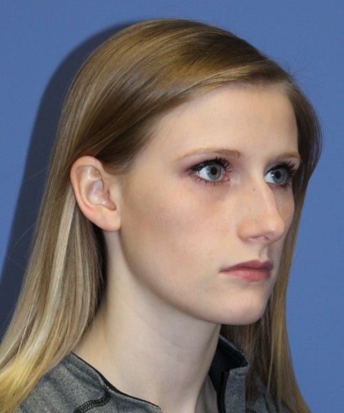 Rhinoplasty 1751 – Click HERE for more views before photo. Individual results may vary.