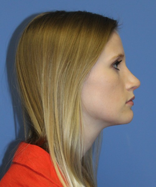 Rhinoplasty 1751 – Click HERE for more views after photo. Individual results may vary.