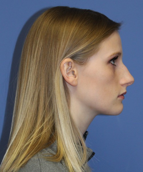 Rhinoplasty 1751 – Click HERE for more views before photo. Individual results may vary.