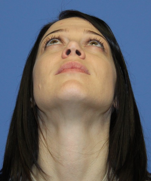 Rhinoplasty 1752 – Click HERE for more views after photo. Individual results may vary.