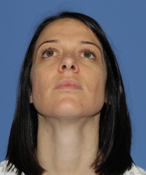 Rhinoplasty 1752 – Click HERE for more views before photo. Individual results may vary.