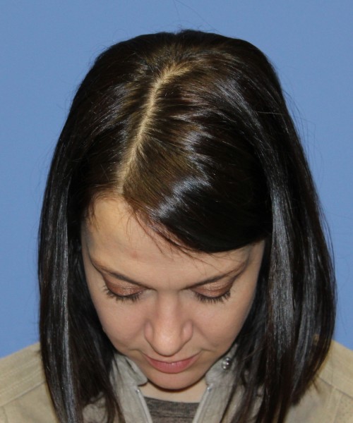 Rhinoplasty 1752 – Click HERE for more views after photo. Individual results may vary.