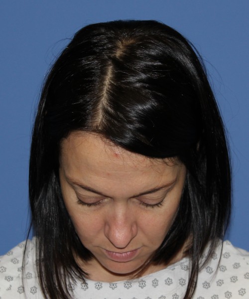 Rhinoplasty 1752 – Click HERE for more views before photo. Individual results may vary.