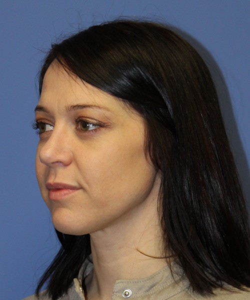 Rhinoplasty 1752 – Click HERE for more views after photo. Individual results may vary.