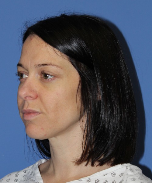 Rhinoplasty 1752 – Click HERE for more views before photo. Individual results may vary.