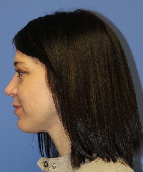 Rhinoplasty 1752 – Click HERE for more views after photo. Individual results may vary.
