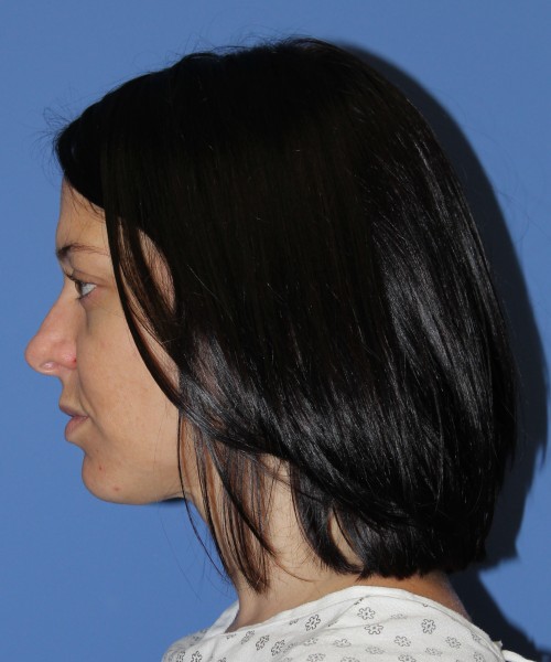 Rhinoplasty 1752 – Click HERE for more views before photo. Individual results may vary.
