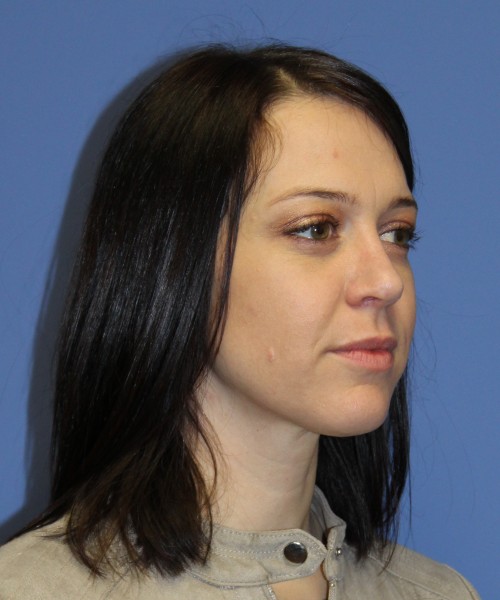Rhinoplasty 1752 – Click HERE for more views after photo. Individual results may vary.
