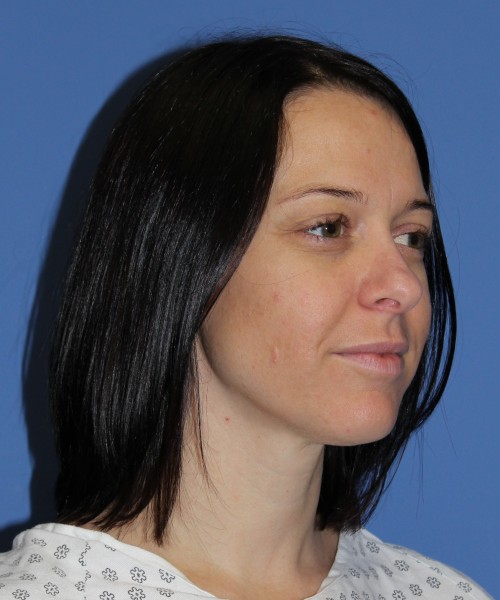 Rhinoplasty 1752 – Click HERE for more views before photo. Individual results may vary.