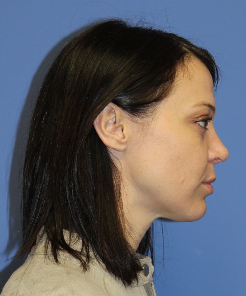 Rhinoplasty 1752 – Click HERE for more views after photo. Individual results may vary.