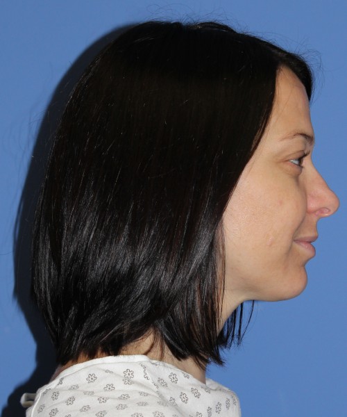 Rhinoplasty 1752 – Click HERE for more views before photo. Individual results may vary.