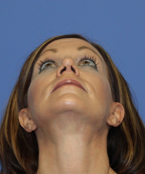 Facelift, Browlift, Rhinoplasty 1976 – Click HERE for more views after photo. Individual results may vary.
