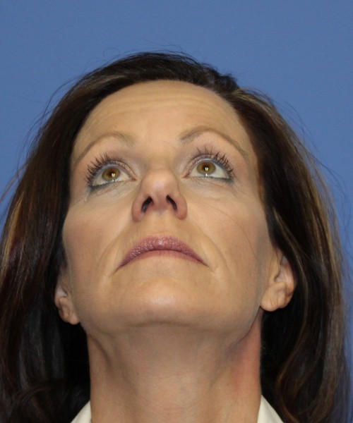 Facelift, Browlift, Rhinoplasty 1976 – Click HERE for more views before photo. Individual results may vary.