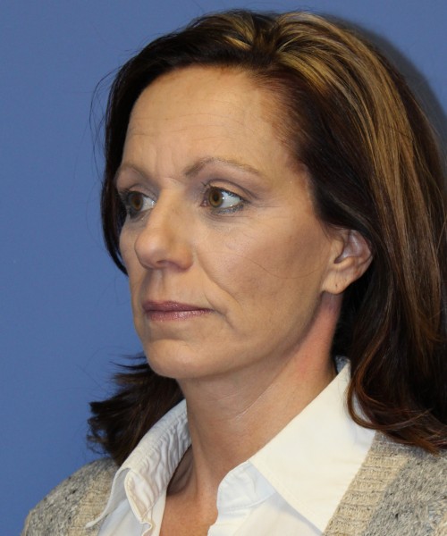 Facelift, Browlift, Rhinoplasty 1976 – Click HERE for more views before photo. Individual results may vary.