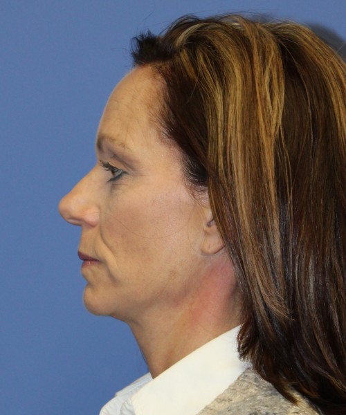 Facelift, Browlift, Rhinoplasty 1976 – Click HERE for more views before photo. Individual results may vary.