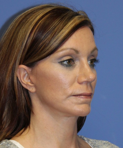 Facelift, Browlift, Rhinoplasty 1976 – Click HERE for more views after photo. Individual results may vary.