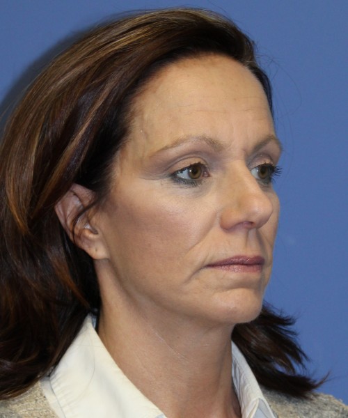Facelift, Browlift, Rhinoplasty 1976 – Click HERE for more views before photo. Individual results may vary.