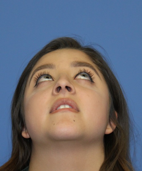 Rhinoplasty 1991 – Click HERE for more views before photo. Individual results may vary.