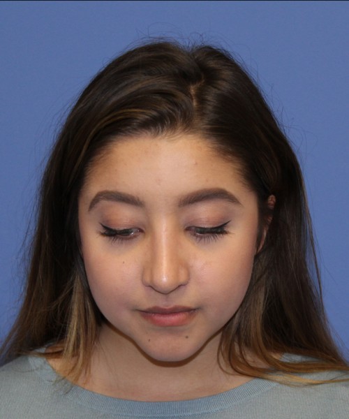Rhinoplasty 1991 – Click HERE for more views after photo. Individual results may vary.