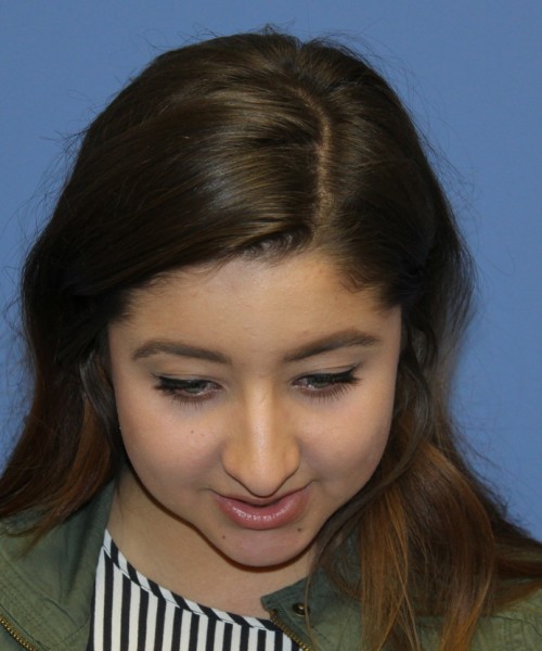 Rhinoplasty 1991 – Click HERE for more views before photo. Individual results may vary.