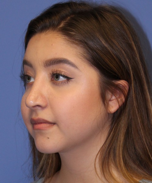 Rhinoplasty 1991 – Click HERE for more views after photo. Individual results may vary.