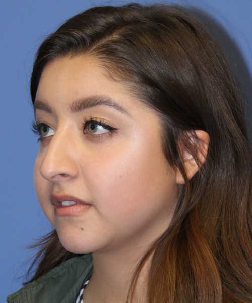Rhinoplasty 1991 – Click HERE for more views before photo. Individual results may vary.