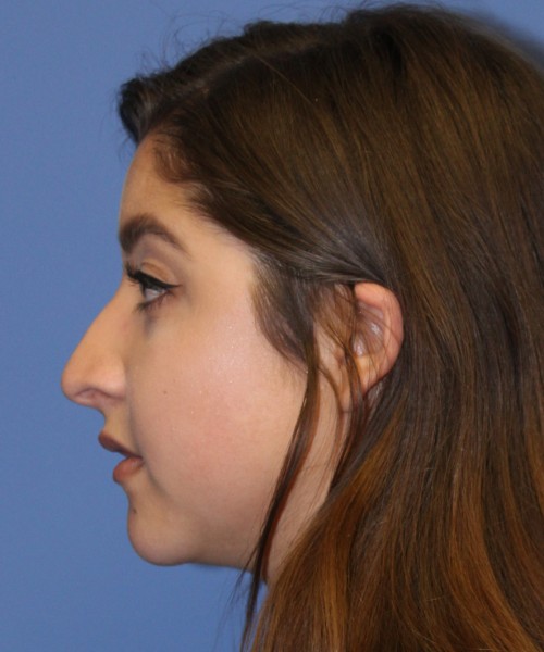 Rhinoplasty 1991 – Click HERE for more views before photo. Individual results may vary.