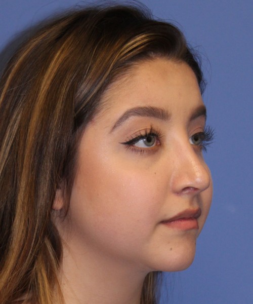 Rhinoplasty 1991 – Click HERE for more views after photo. Individual results may vary.