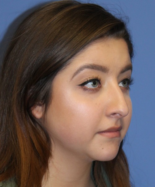 Rhinoplasty 1991 – Click HERE for more views before photo. Individual results may vary.