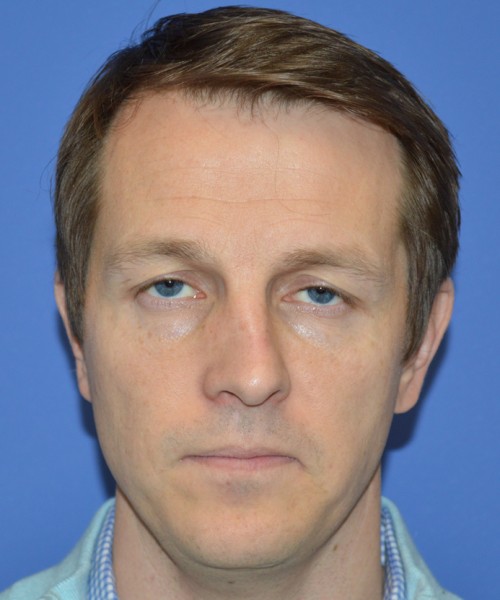 Rhinoplasty 2017 – Click HERE for more views before photo. Individual results may vary.