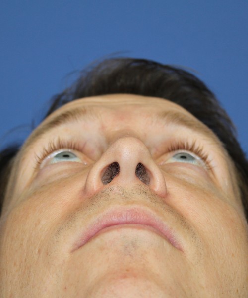 Rhinoplasty 2017 – Click HERE for more views after photo. Individual results may vary.