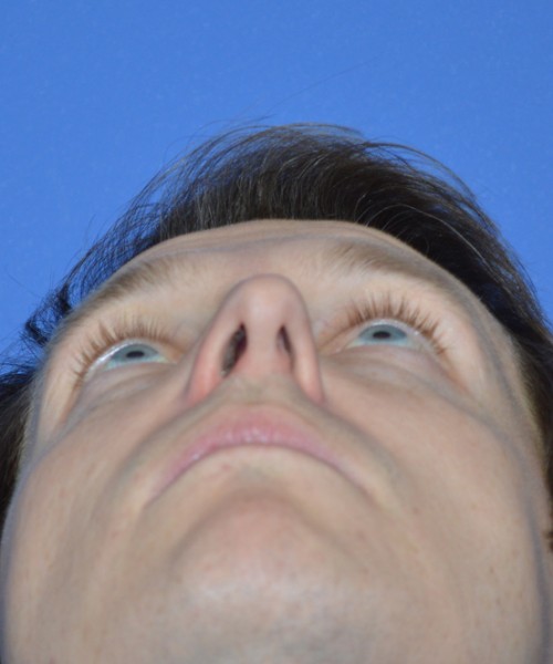 Rhinoplasty 2017 – Click HERE for more views before photo. Individual results may vary.