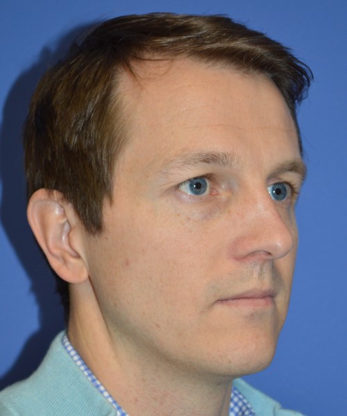 Rhinoplasty 2017 – Click HERE for more views before photo. Individual results may vary.