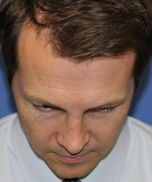 Rhinoplasty 2017 – Click HERE for more views after photo. Individual results may vary.