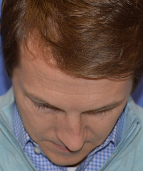 Rhinoplasty 2017 – Click HERE for more views before photo. Individual results may vary.