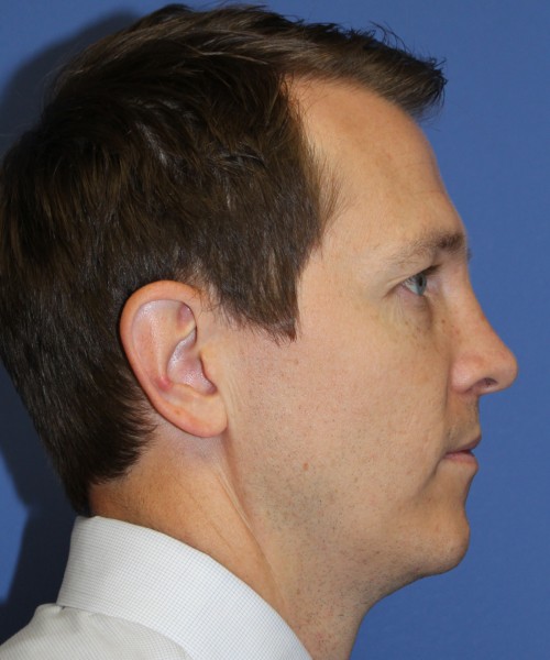 Rhinoplasty 2017 – Click HERE for more views after photo. Individual results may vary.