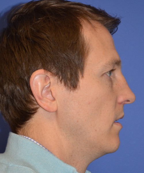 Rhinoplasty 2017 – Click HERE for more views before photo. Individual results may vary.