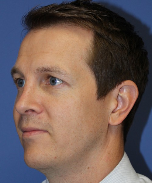 Rhinoplasty 2017 – Click HERE for more views after photo. Individual results may vary.