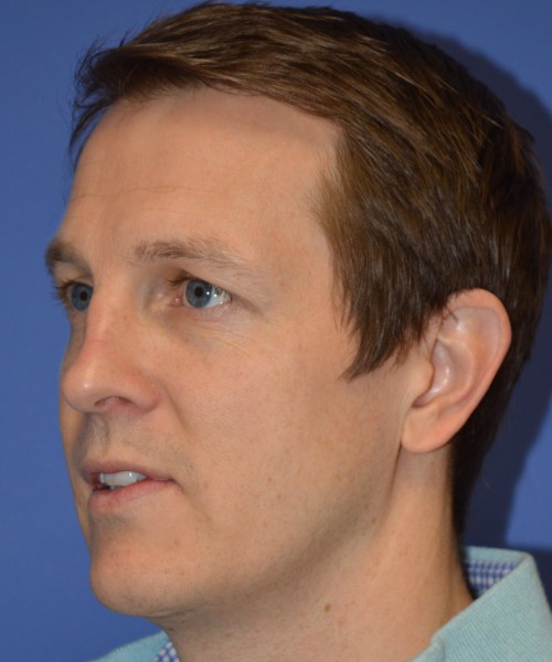 Rhinoplasty 2017 – Click HERE for more views before photo. Individual results may vary.