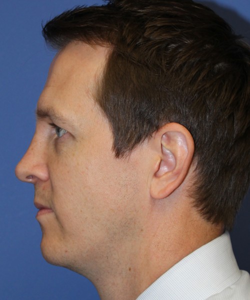 Rhinoplasty 2017 – Click HERE for more views after photo. Individual results may vary.