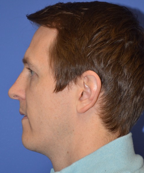Rhinoplasty 2017 – Click HERE for more views before photo. Individual results may vary.