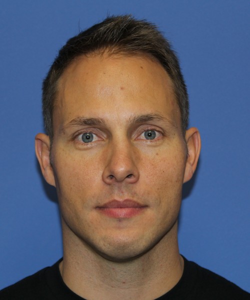 Rhinoplasty 2032 – Click HERE for more views before photo. Individual results may vary.