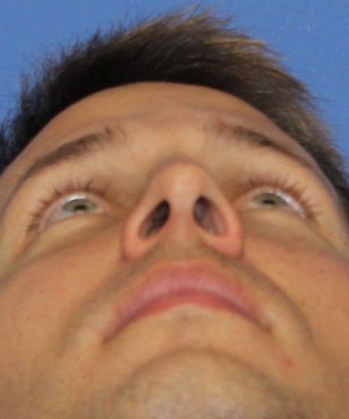 Rhinoplasty 2032 – Click HERE for more views after photo. Individual results may vary.