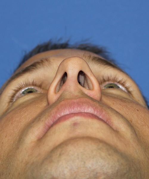 Rhinoplasty 2032 – Click HERE for more views before photo. Individual results may vary.