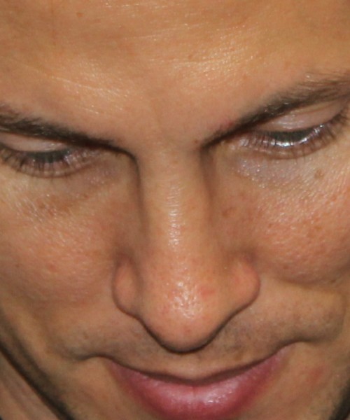 Rhinoplasty 2032 – Click HERE for more views after photo. Individual results may vary.