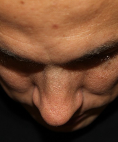 Rhinoplasty 2032 – Click HERE for more views before photo. Individual results may vary.