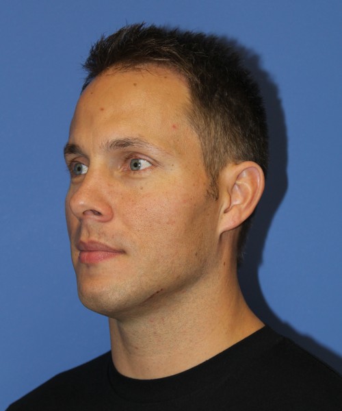 Rhinoplasty 2032 – Click HERE for more views before photo. Individual results may vary.